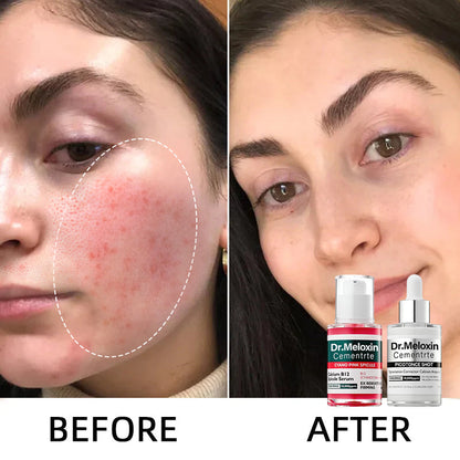 Shrinks Pores & Fades Blemish Marks