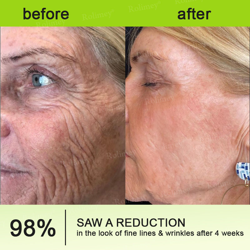 ☀️Made and shipped from the UK 💫Rolimey® Botox & Vita-A Retinol Shot Wrinkle-Lift Tightening cream - Last Day Promotion 70% OFF