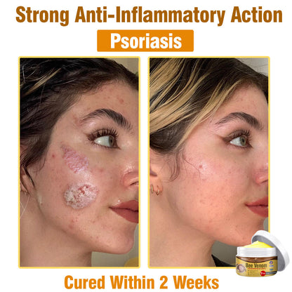 🐝💖 Flysmus™ Bee Venom Comprehensive Cream 🇺🇸 Dermatologist Recommended