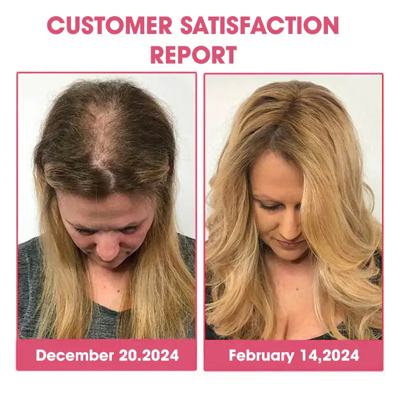 🫧DeeVoo™ Luxe Bee Venom Scalp Treatment HairGrᴏᴡth Hair Spray(Hurry! 80% OFF - Only 30 minutes left 🫧)